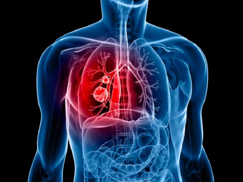 سرطان ریه چیست؟