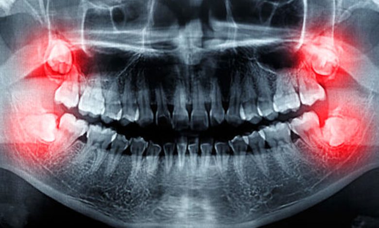 کشیدن دندان عقل و نباید های آن