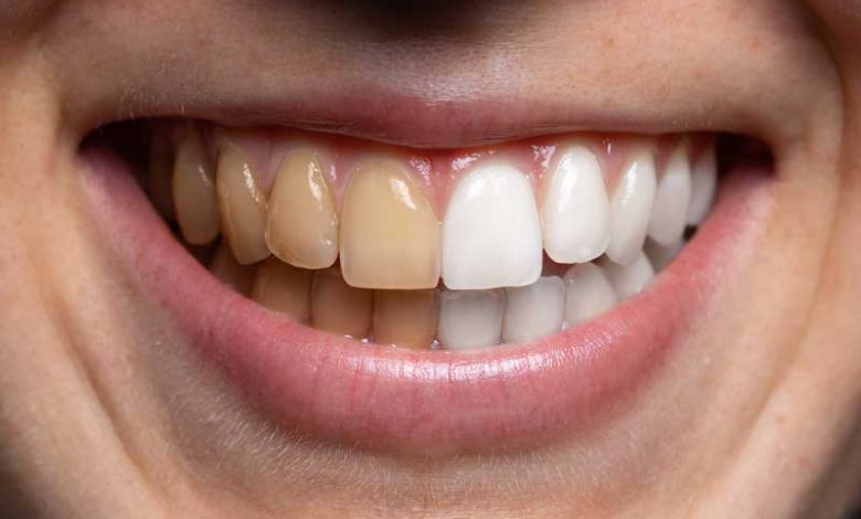 جرم گیری دندان با روش مختلف