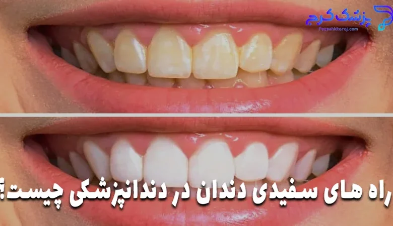 راه های سفیدی دندان در دندانپزشکی